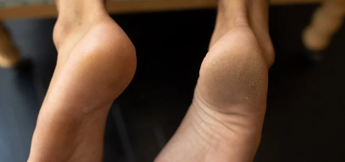 How To Get Rid Of Calluses On Feet